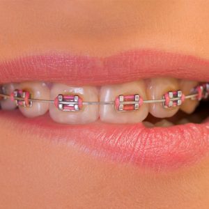 what-to-expect-when-getting-braces-on-top-teeth-only-Fine-orthodontist-Sydney